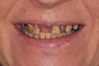 Smile In A Day 2 before